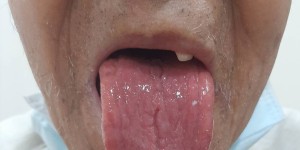 吃巧克力导致口腔灼痛?医生揭秘:竟是对“蟑螂过敏”!