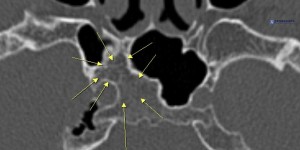 一侧眼球无法转动 七旬老人患罕见蝶骨体感染